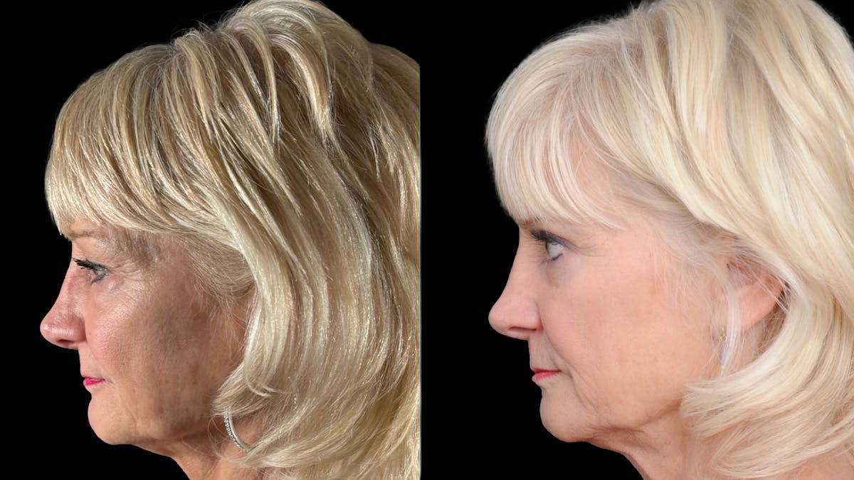 Lower Eyelid Surgery Before & After Gallery - Patient 358996 - Image 3