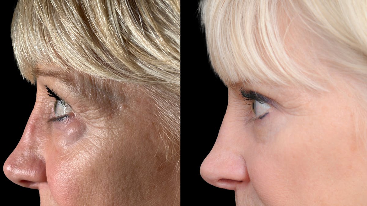 Lower Eyelid Surgery Before & After Gallery - Patient 358996 - Image 10