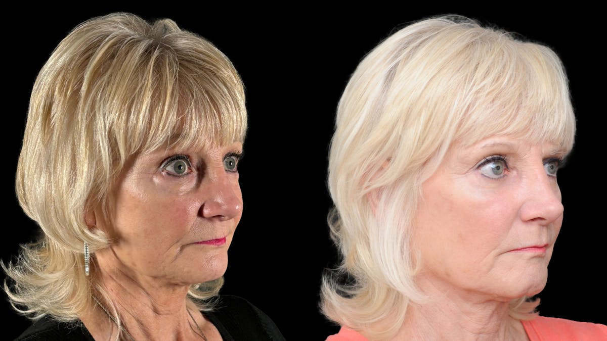 Lower Eyelid Surgery Before & After Gallery - Patient 358996 - Image 4