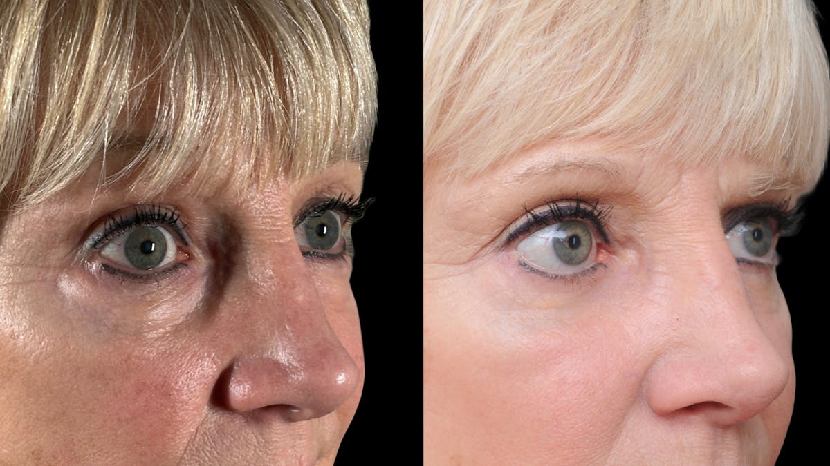 Lower Eyelid Surgery Before & After Gallery - Patient 358996 - Image 11