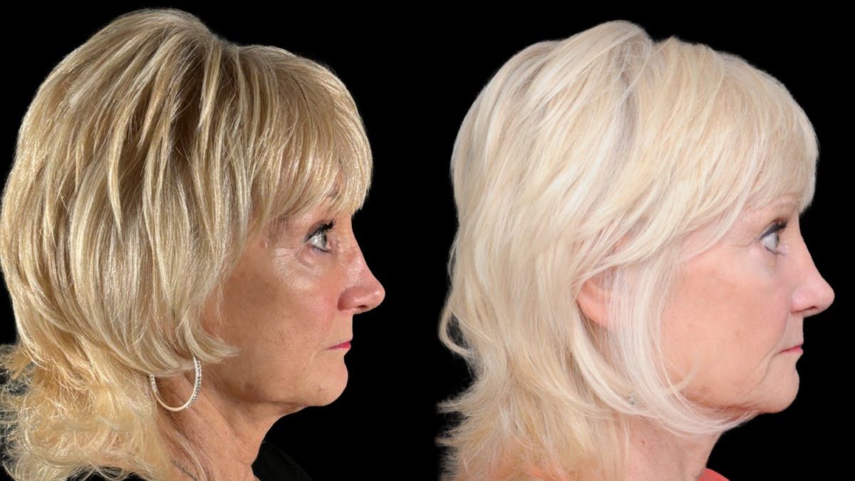 Lower Eyelid Surgery Before & After Gallery - Patient 358996 - Image 5