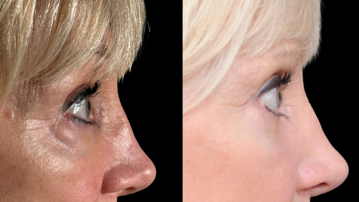 Lower Eyelid Surgery Before & After Gallery - Patient 358996 - Image 12