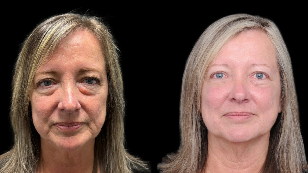 Lower Eyelid Surgery Before & After Gallery - Patient 409304 - Image 2