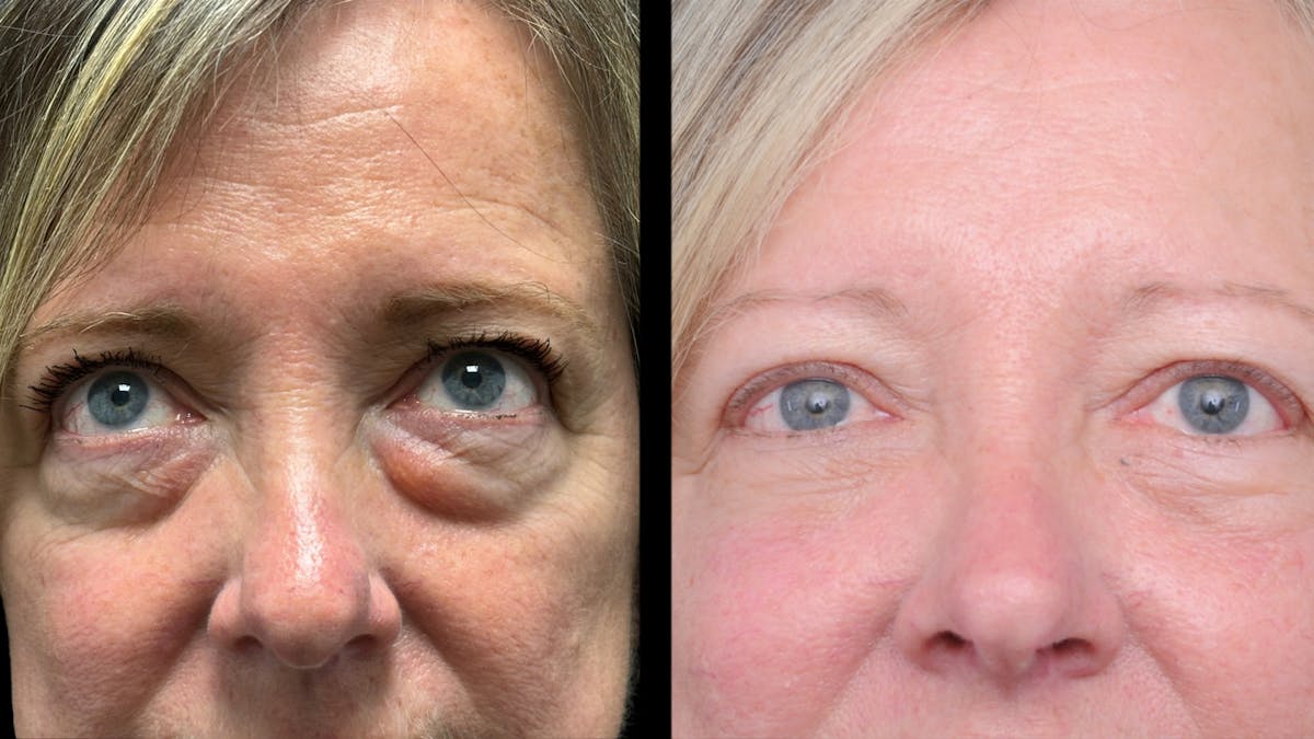 Lower Eyelid Surgery Before & After Gallery - Patient 409304 - Image 6