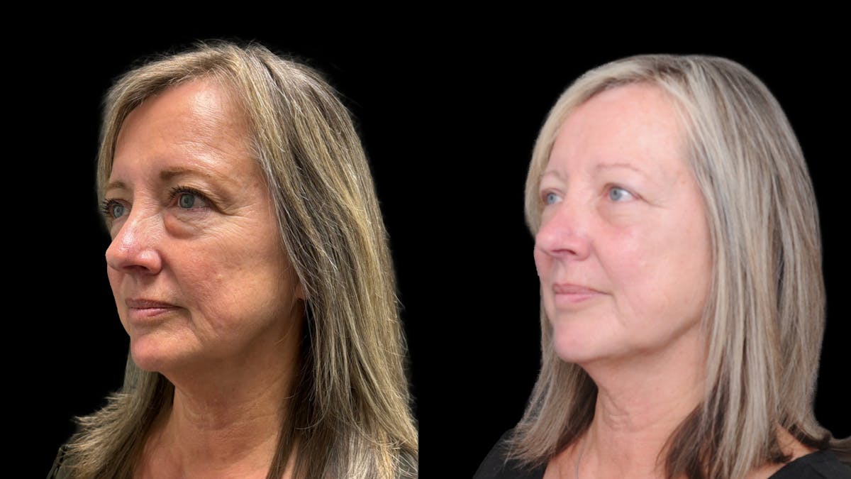 Lower Eyelid Surgery Before & After Gallery - Patient 409304 - Image 1