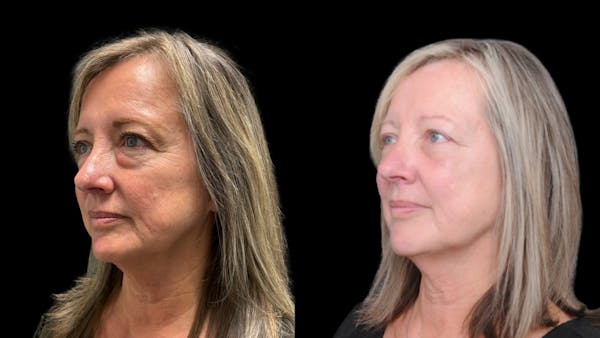 Lower Eyelid Surgery Before & After Gallery - Patient 409304 - Image 1