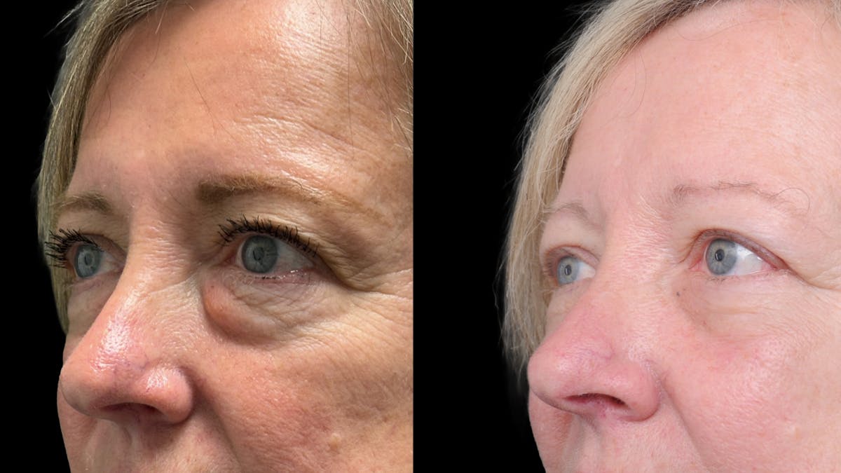 Lower Eyelid Surgery Before & After Gallery - Patient 409304 - Image 7