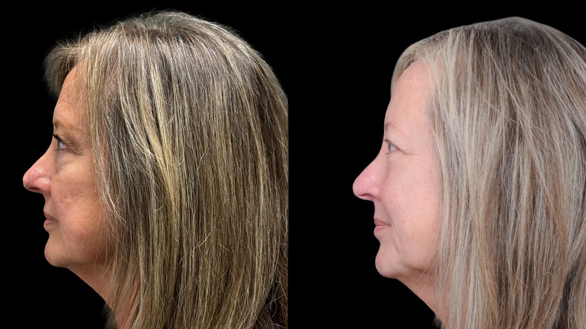 Lower Eyelid Surgery Before & After Gallery - Patient 409304 - Image 3