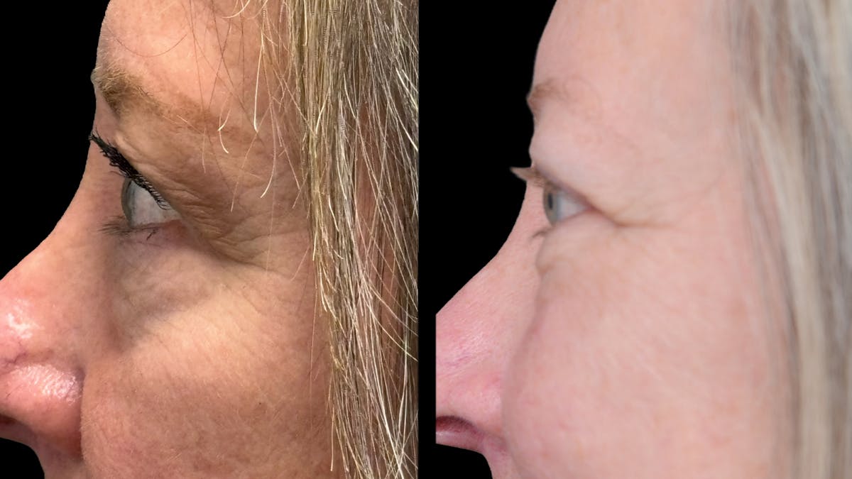 Lower Eyelid Surgery Before & After Gallery - Patient 409304 - Image 8
