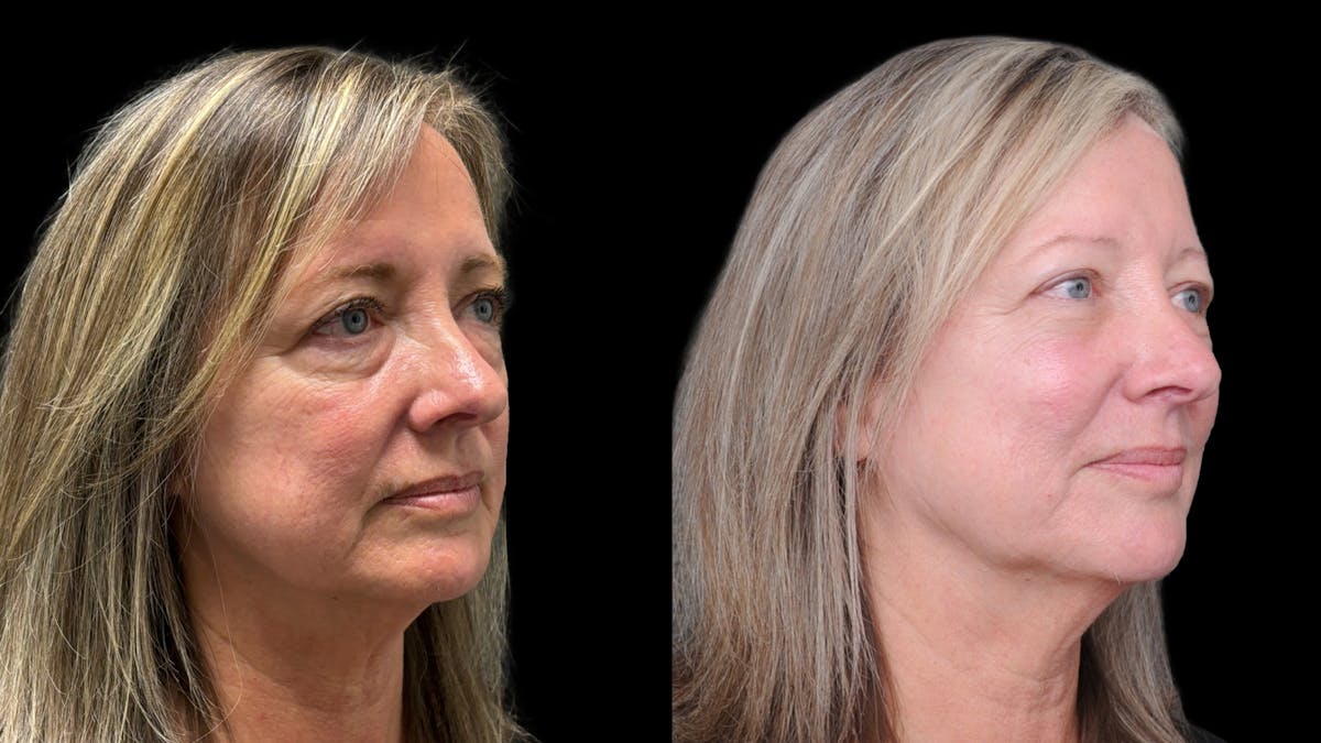 Lower Eyelid Surgery Before & After Gallery - Patient 409304 - Image 4
