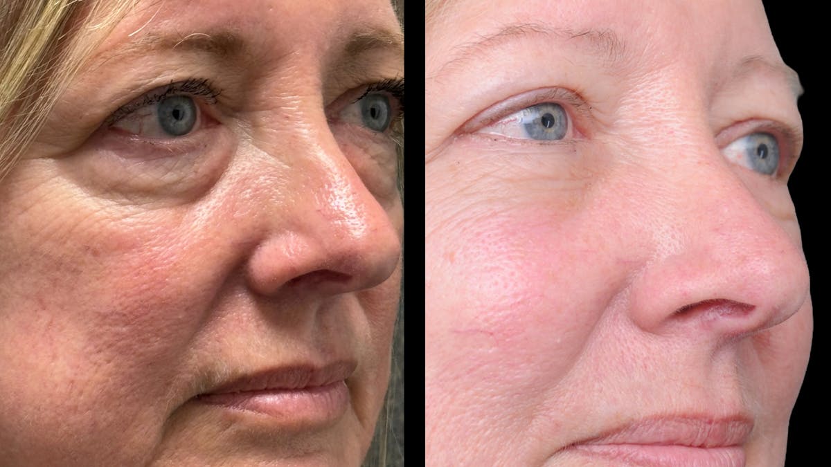 Lower Eyelid Surgery Before & After Gallery - Patient 409304 - Image 9