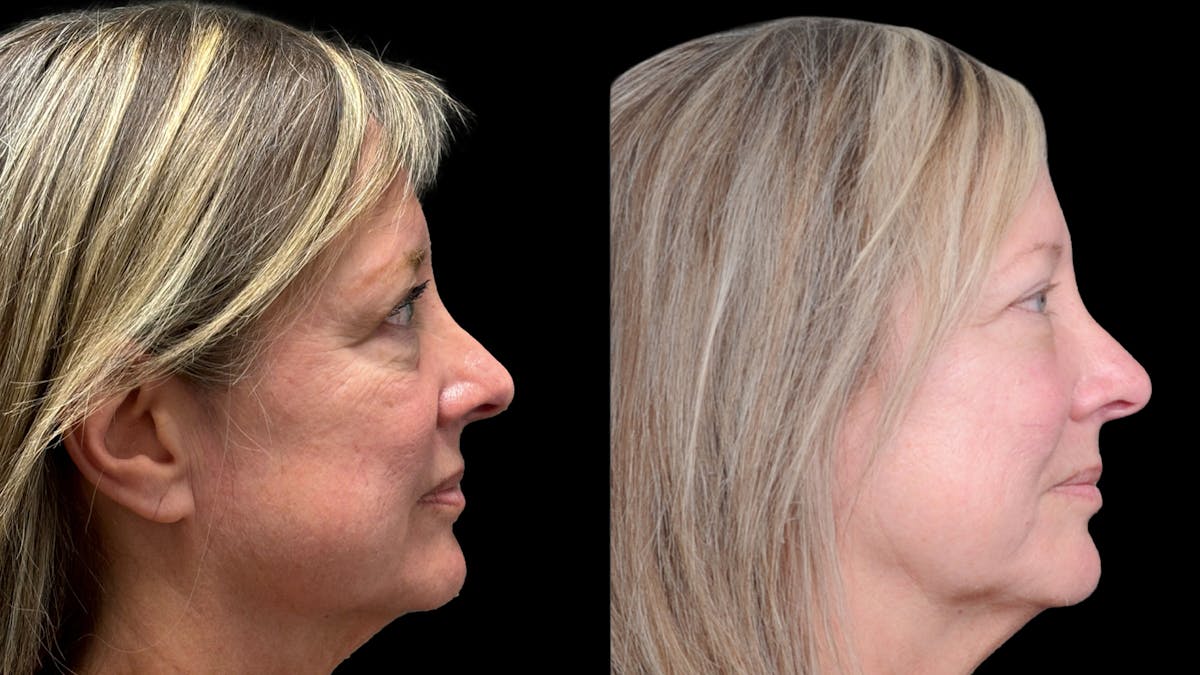 Lower Eyelid Surgery Before & After Gallery - Patient 409304 - Image 5