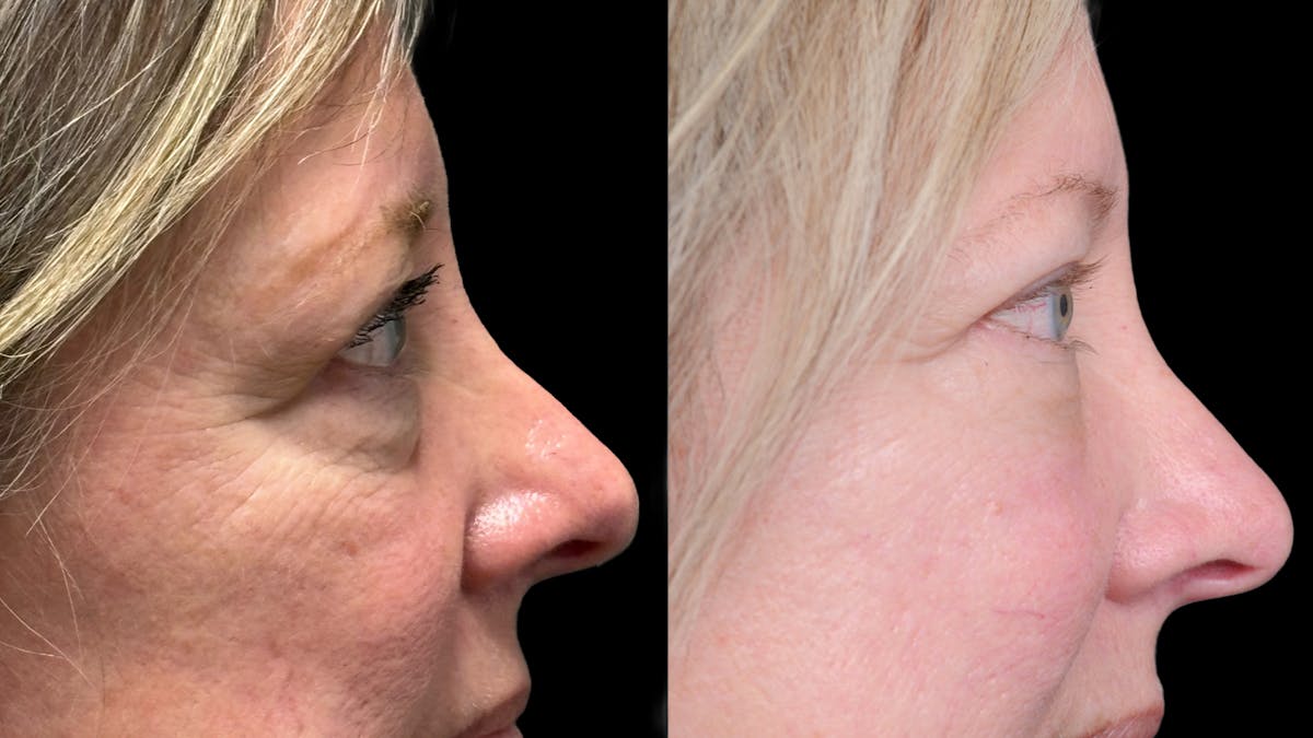 Lower Eyelid Surgery Before & After Gallery - Patient 409304 - Image 10