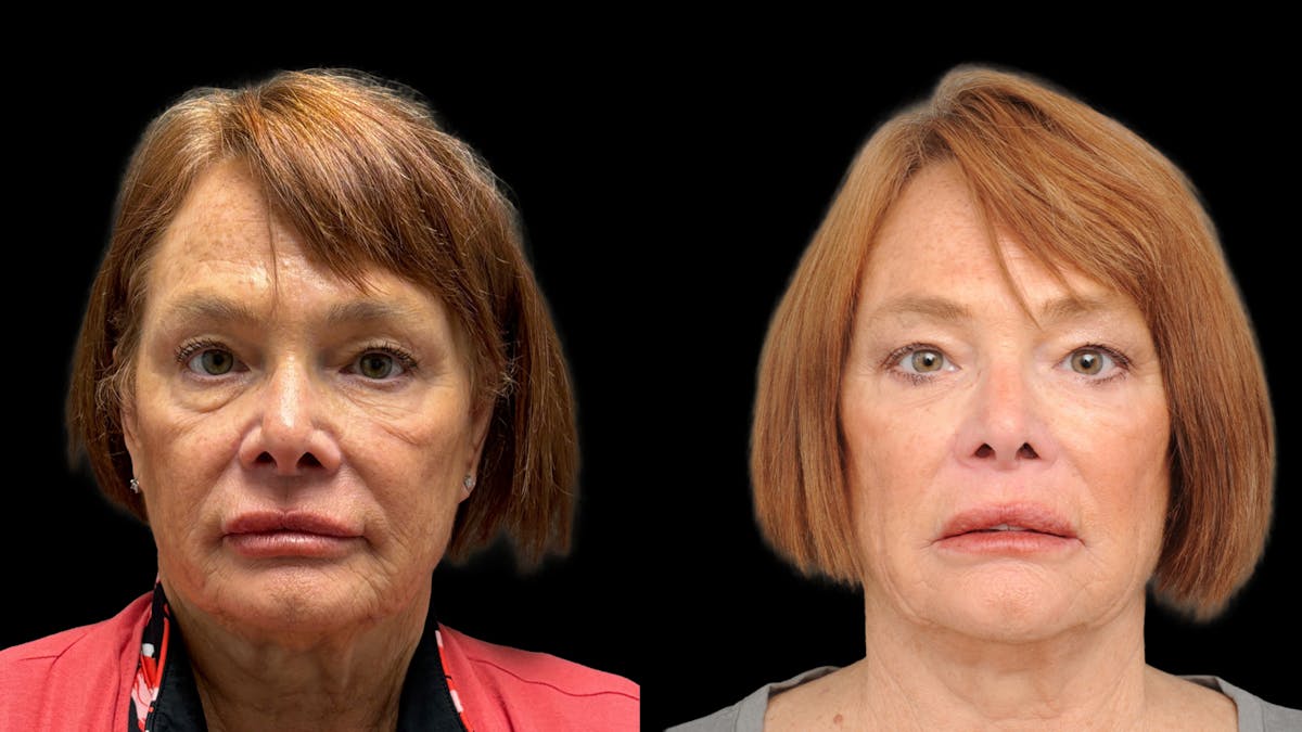 Lower Eyelid Surgery Before & After Gallery - Patient 318392 - Image 2