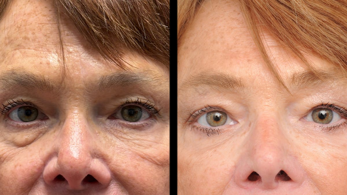 Lower Eyelid Surgery Before & After Gallery - Patient 318392 - Image 5