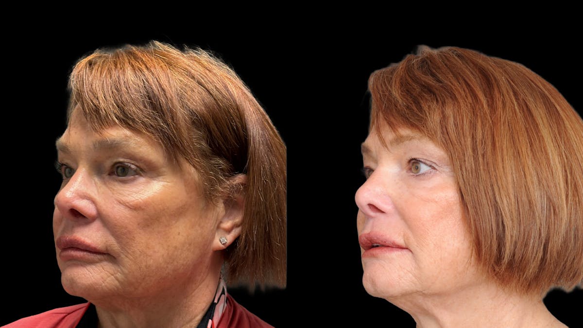 Lower Eyelid Surgery Before & After Gallery - Patient 318392 - Image 1