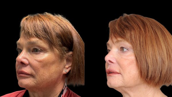 Lower Eyelid Surgery Before & After Gallery - Patient 318392 - Image 1