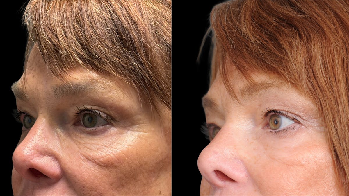 Lower Eyelid Surgery Before & After Gallery - Patient 318392 - Image 6
