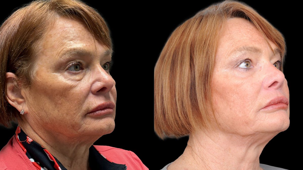 Lower Eyelid Surgery Before & After Gallery - Patient 318392 - Image 3