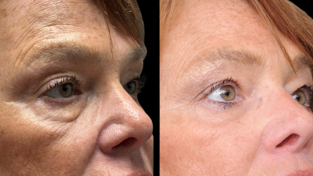 Lower Eyelid Surgery Before & After Gallery - Patient 318392 - Image 7