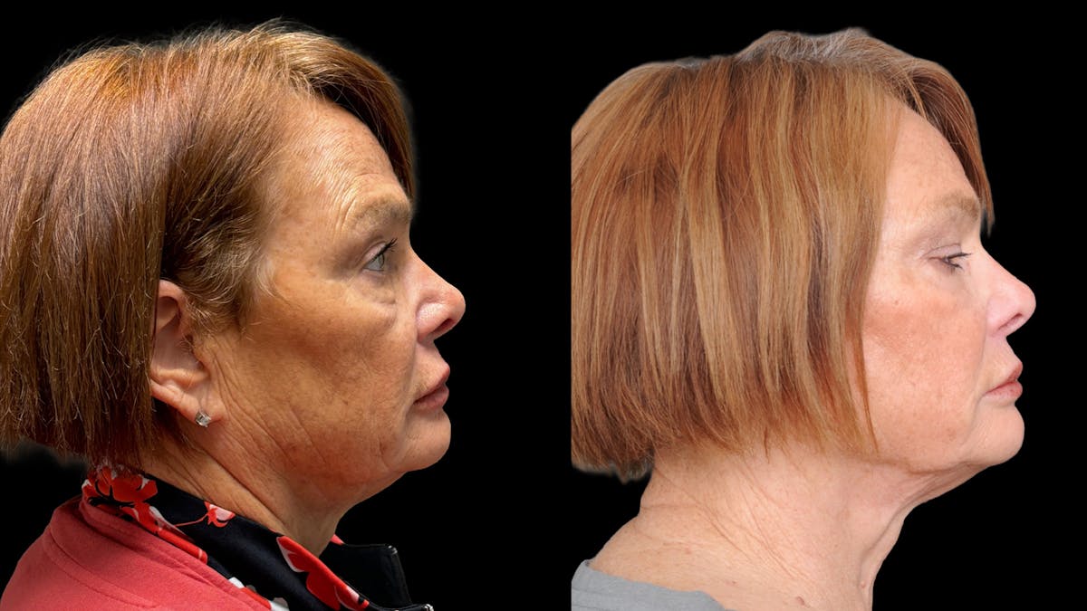 Lower Eyelid Surgery Before & After Gallery - Patient 318392 - Image 4