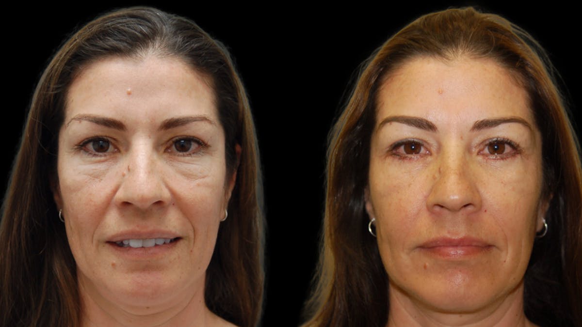 Lower Eyelid Surgery Before & After Gallery - Patient 241410 - Image 2