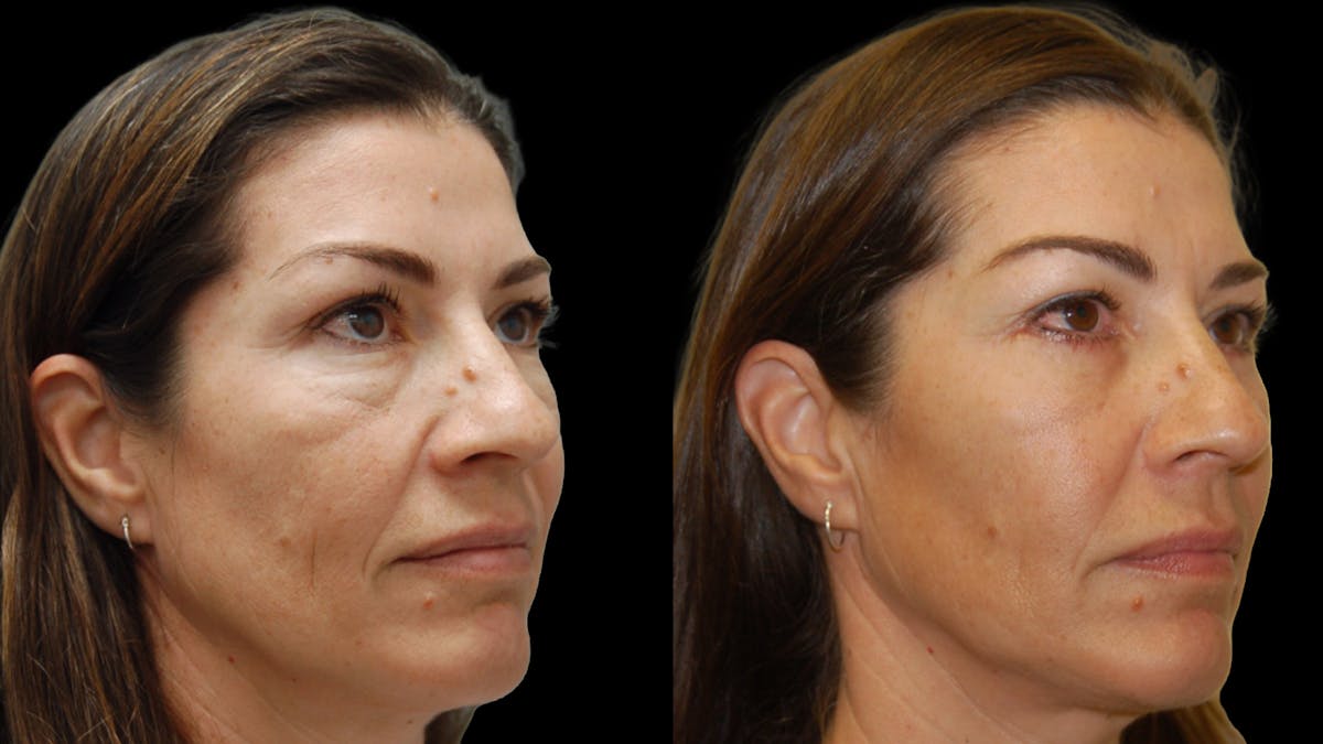 Lower Eyelid Surgery Before & After Gallery - Patient 241410 - Image 3
