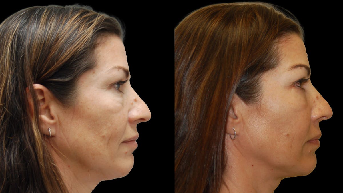 Lower Eyelid Surgery Before & After Gallery - Patient 241410 - Image 4