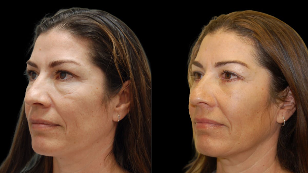 Lower Eyelid Surgery Before & After Gallery - Patient 241410 - Image 1