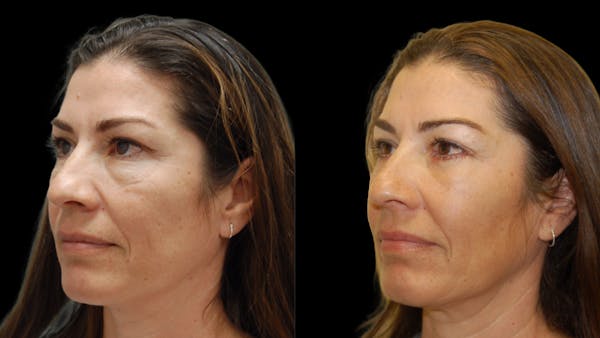 Lower Eyelid Surgery Before & After Gallery - Patient 241410 - Image 1