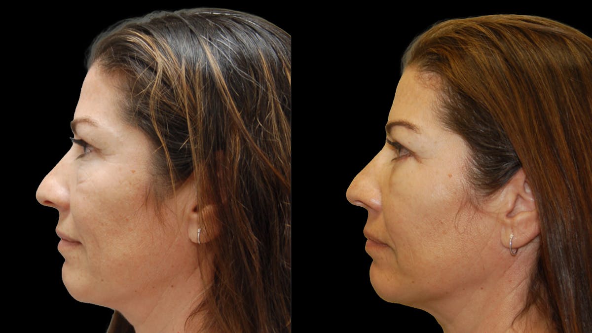 Lower Eyelid Surgery Before & After Gallery - Patient 241410 - Image 5