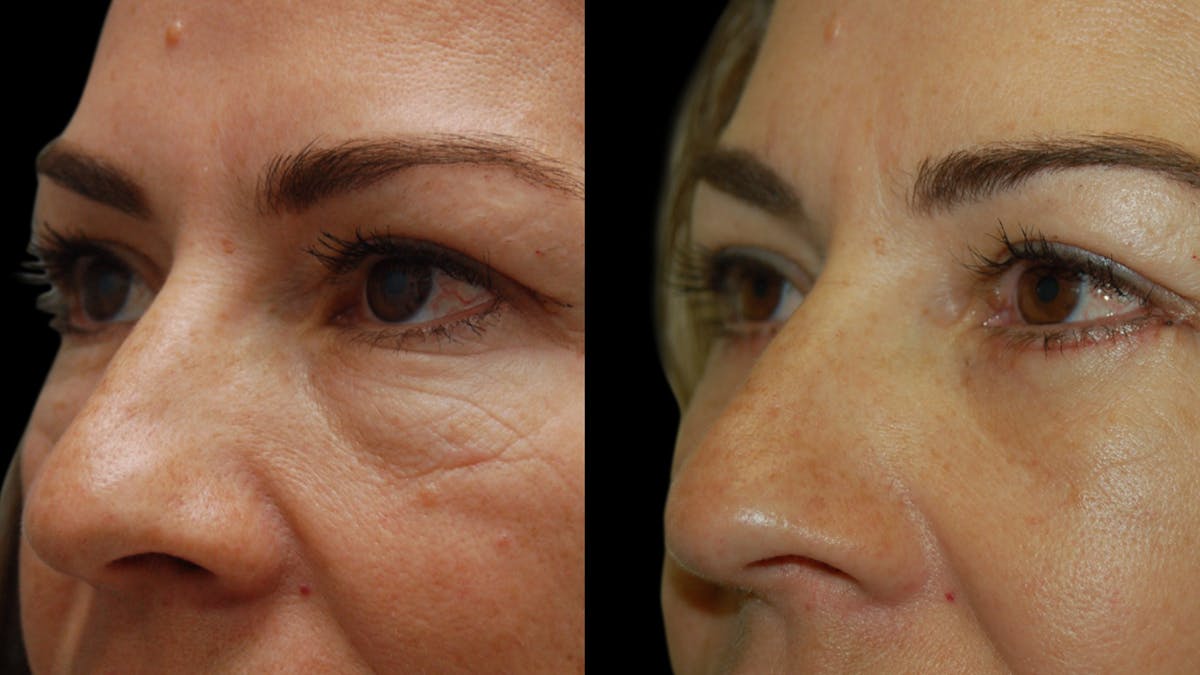 Lower Eyelid Surgery Before & After Gallery - Patient 241410 - Image 6