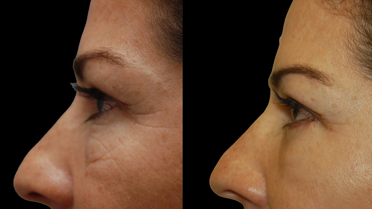Lower Eyelid Surgery Before & After Gallery - Patient 241410 - Image 7