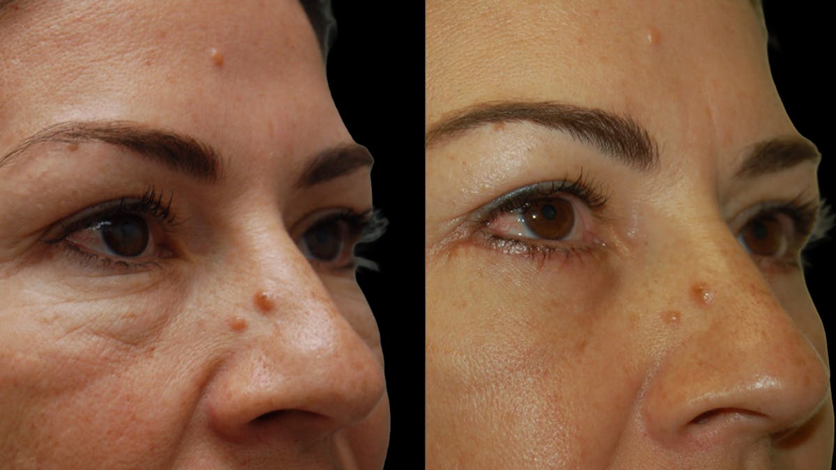 Lower Eyelid Surgery Before & After Gallery - Patient 241410 - Image 8