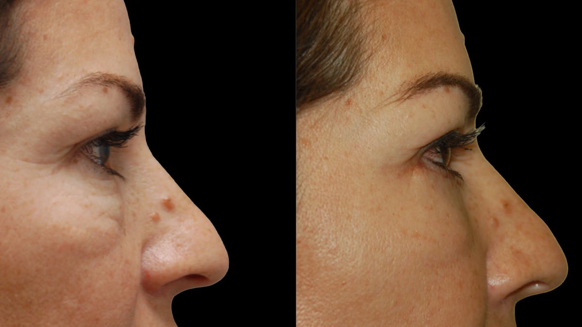 Lower Eyelid Surgery Before & After Gallery - Patient 241410 - Image 9