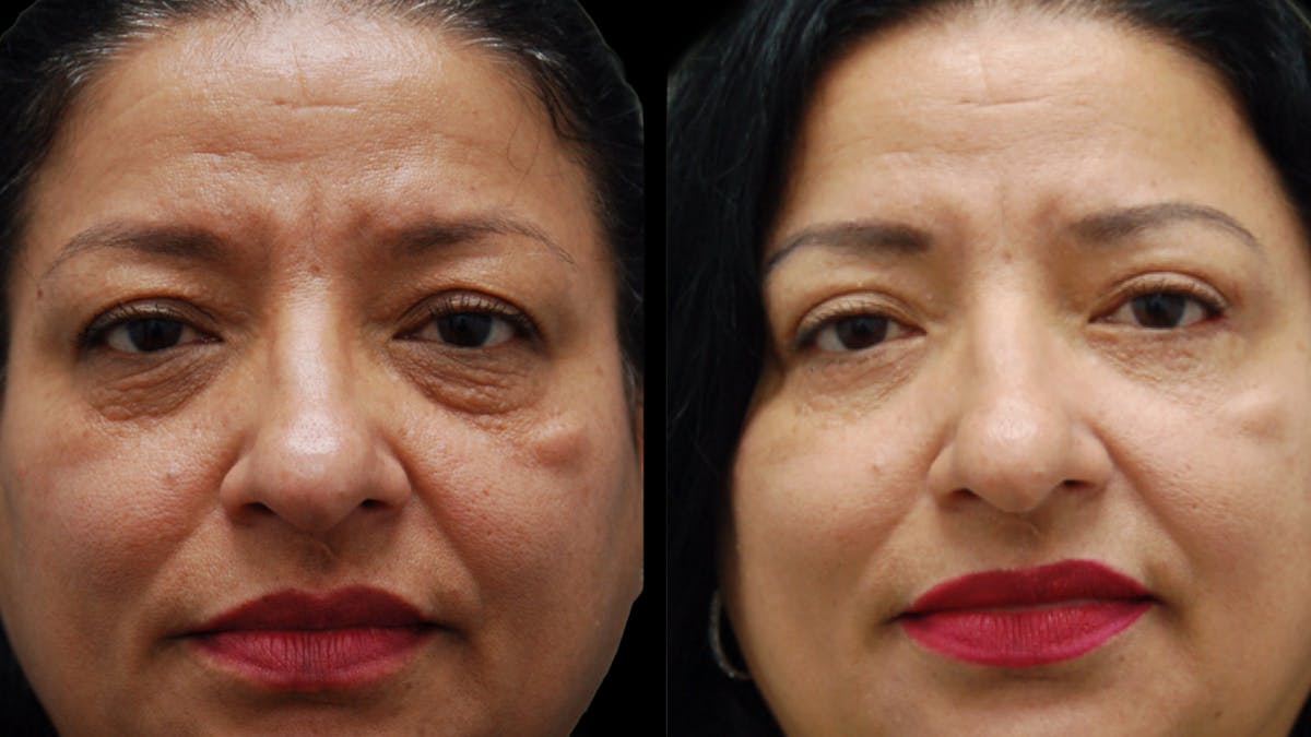 Lower Eyelid Surgery Before & After Gallery - Patient 314136 - Image 2