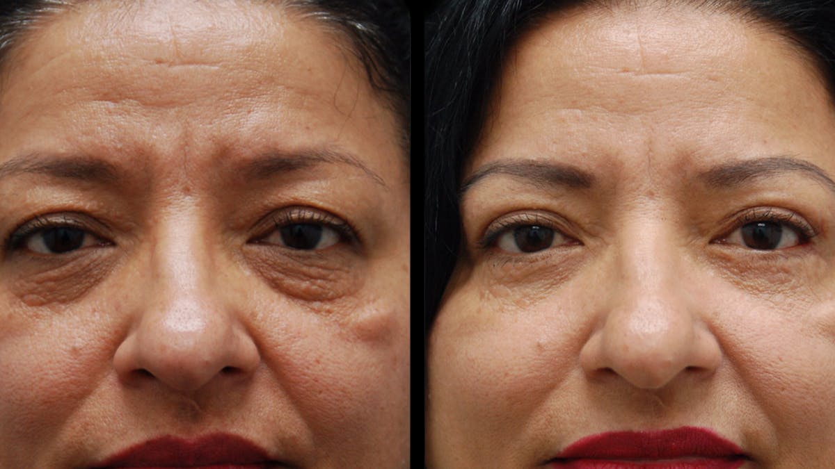 Lower Eyelid Surgery Before & After Gallery - Patient 314136 - Image 3