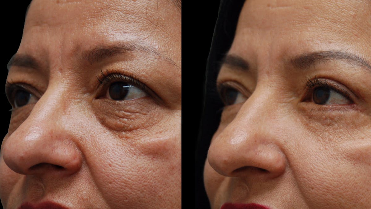 Lower Eyelid Surgery Before & After Gallery - Patient 314136 - Image 4