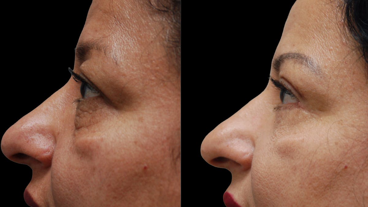 Lower Eyelid Surgery Before & After Gallery - Patient 314136 - Image 5