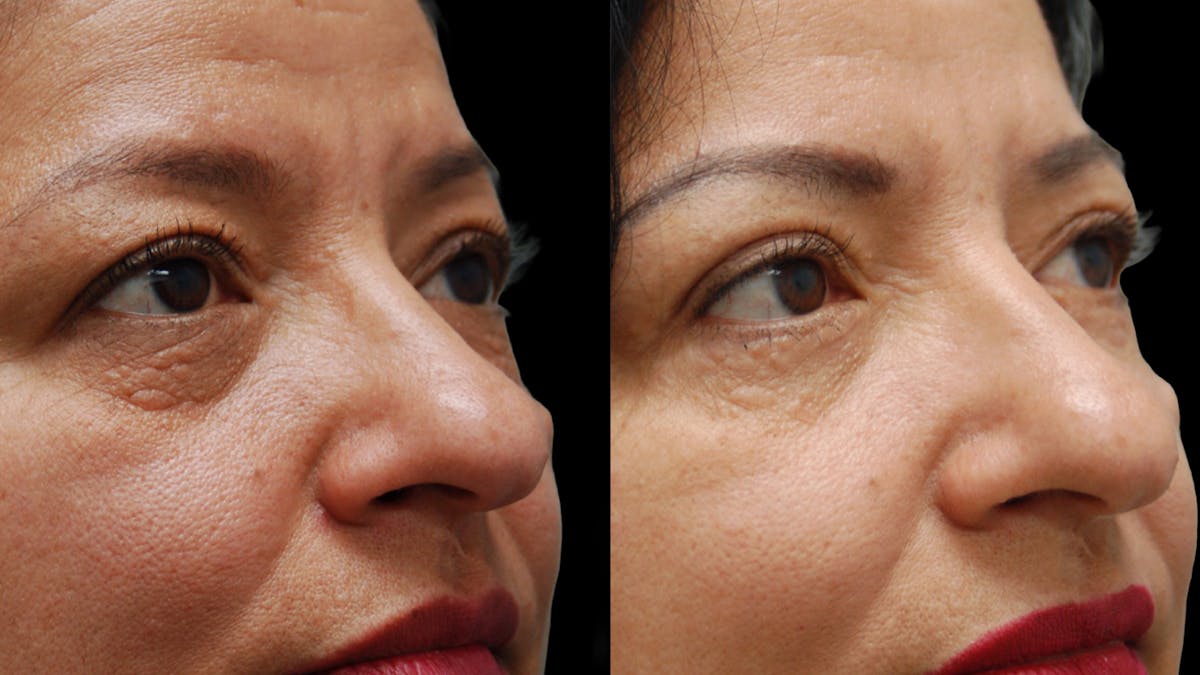 Lower Eyelid Surgery Before & After Gallery - Patient 314136 - Image 6