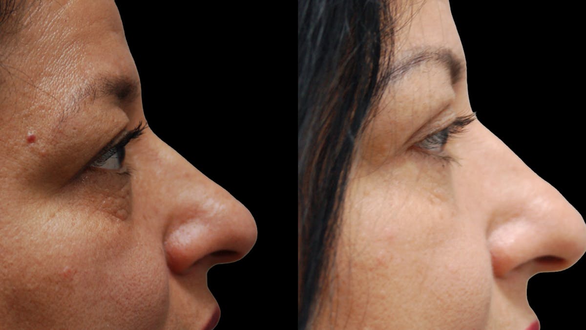 Lower Eyelid Surgery Before & After Gallery - Patient 314136 - Image 7