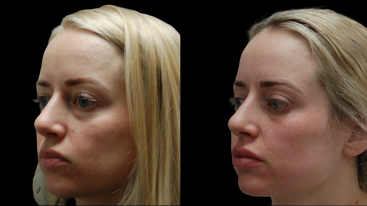 Lower Eyelid Surgery Before & After Gallery - Patient 367254 - Image 1