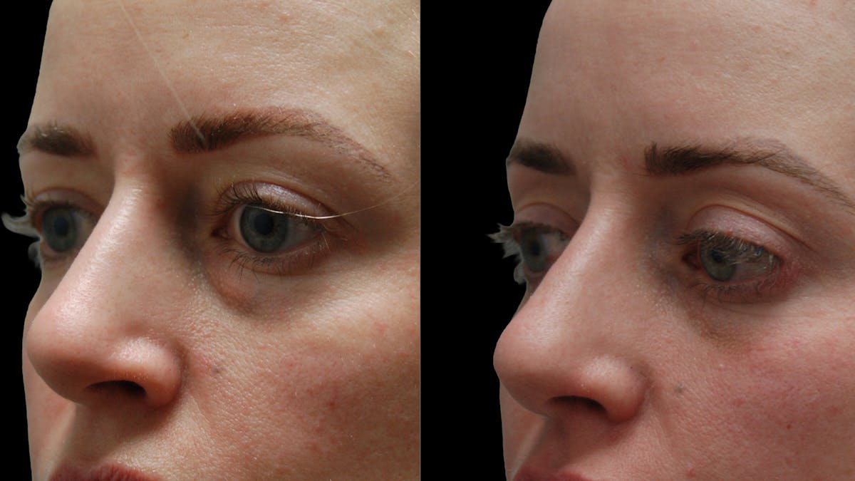 Lower Eyelid Surgery Before & After Gallery - Patient 367254 - Image 5