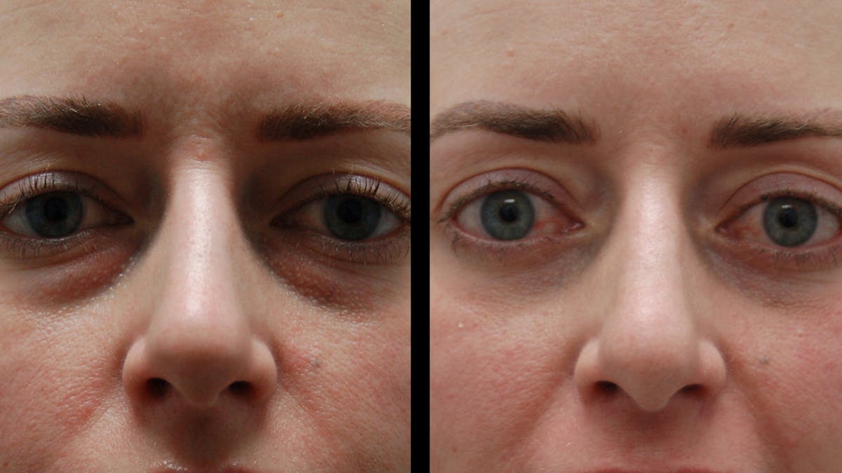 Lower Eyelid Surgery Before & After Gallery - Patient 367254 - Image 6