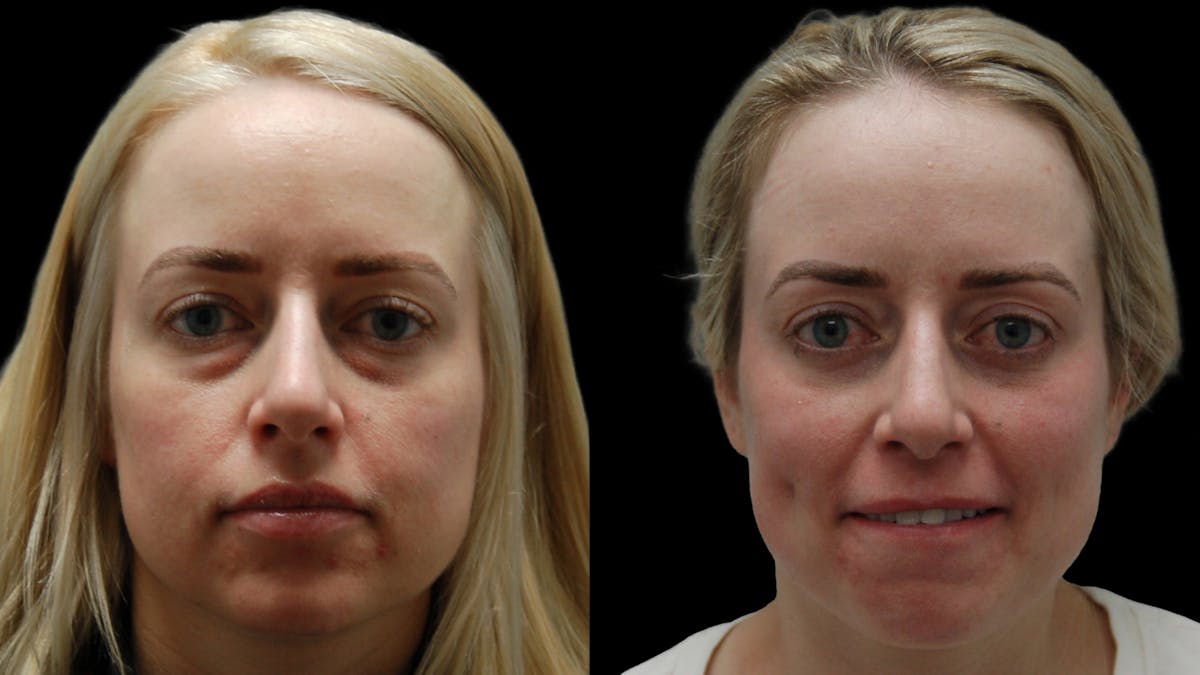 Lower Eyelid Surgery Before & After Gallery - Patient 367254 - Image 2