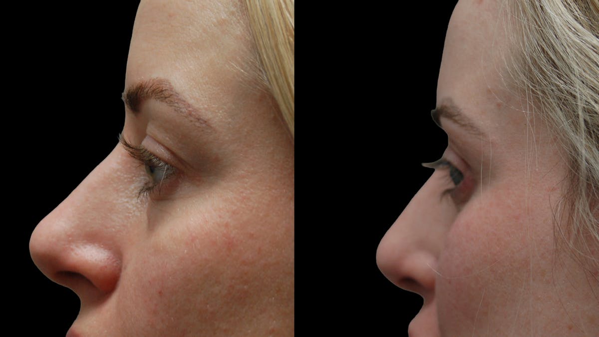 Lower Eyelid Surgery Before & After Gallery - Patient 367254 - Image 7