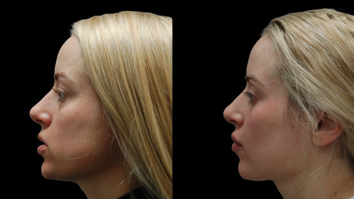 Lower Eyelid Surgery Before & After Gallery - Patient 367254 - Image 4