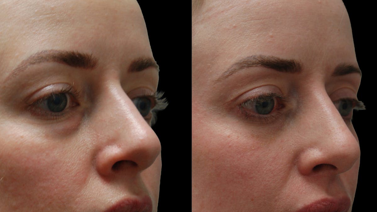 Lower Eyelid Surgery Before & After Gallery - Patient 367254 - Image 8