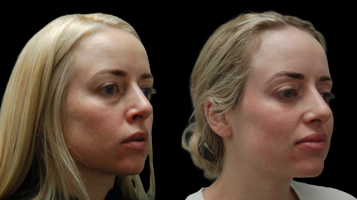 Lower Eyelid Surgery Before & After Gallery - Patient 367254 - Image 3