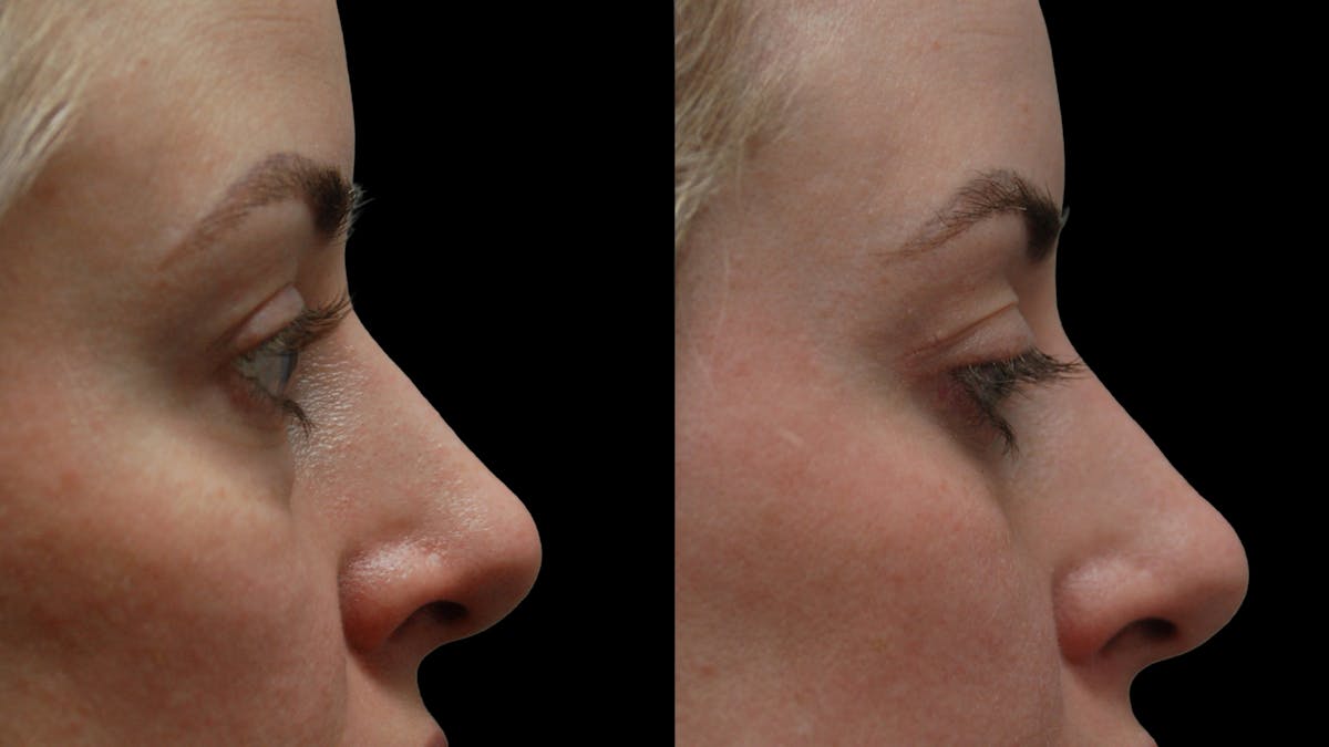 Lower Eyelid Surgery Before & After Gallery - Patient 367254 - Image 9